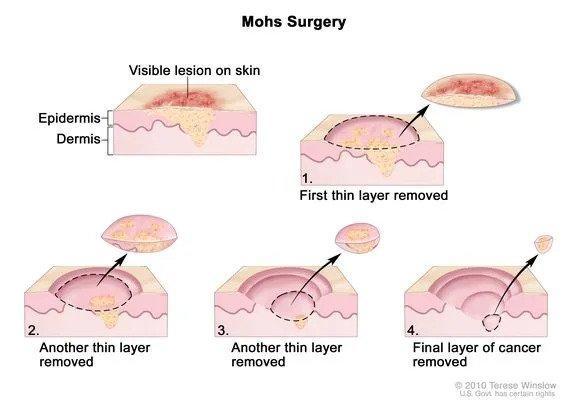 Understanding Mohs Surgery: What to Expect
