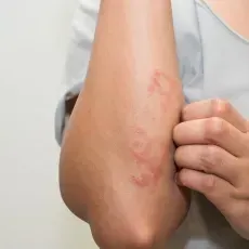Is It Possible To Cure Eczema Completely?