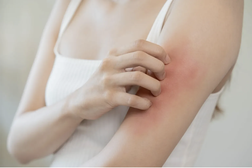 Eczema