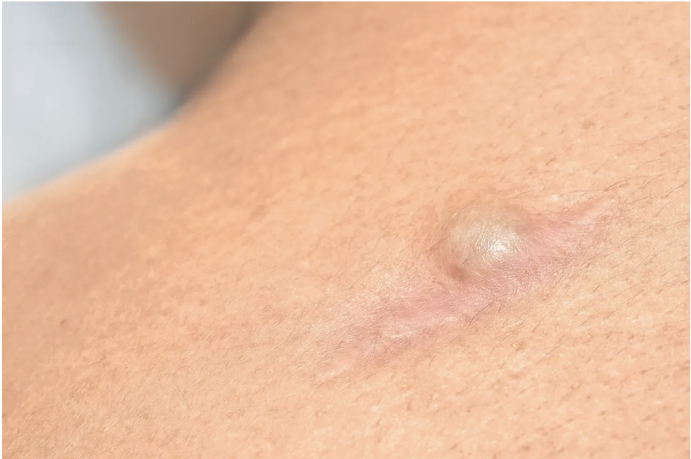 Hidradenitis Suppurativa