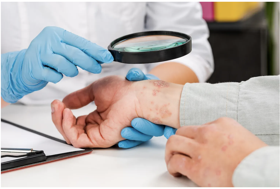 Psoriasis