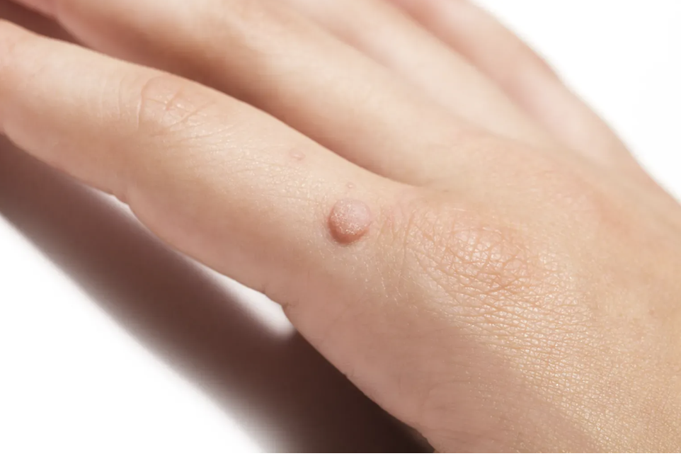 Warts