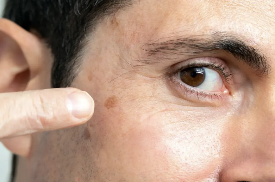Superficial Radiation Treatment (SRT)
