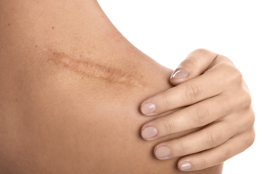 Keloid Scars Removal