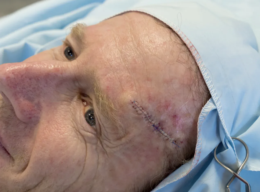 Mohs Surgery